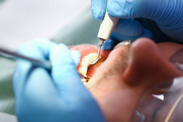 Best Emergency Tooth Extraction in Washgton, IN